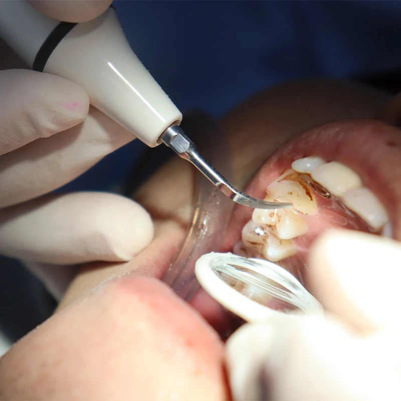 Skaler rękojeść kabel rurowy d – Teeth Whitening Youtube recenzja i cena